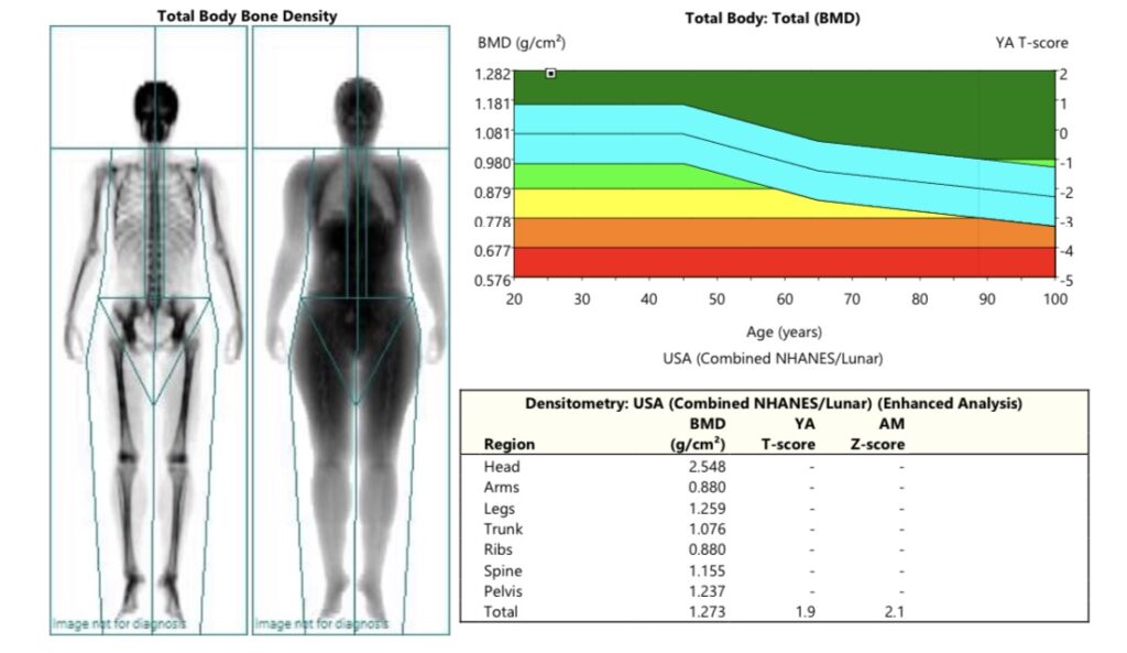 Bone density DEXA scan